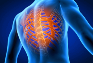 Intercostal neuralgia