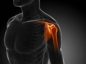 Rotator cuff tear