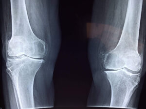 Posterior Cruciate Ligaments of the Knee